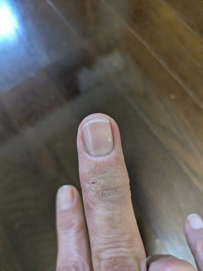 コーヒーアレルギーで何をやっても治らなかった右手中指の手荒れ